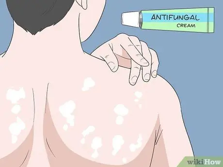 Лечить грибковые прыщи на спине Шаг 3