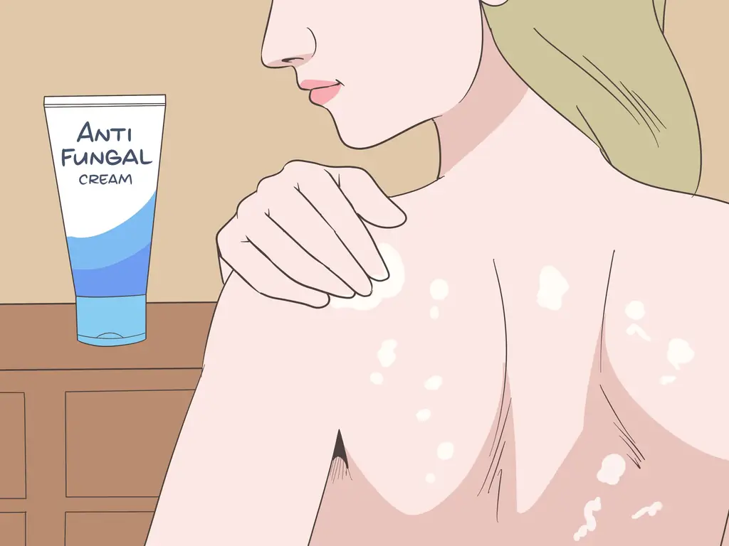 3 способа лечения грибковых прыщей на спине