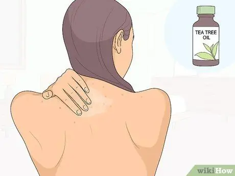 Как избавиться от прыщей на спине, шаг 11