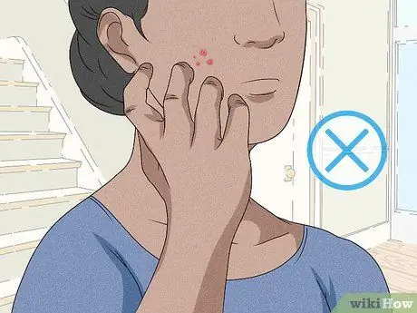 Исцеление от зудящих прыщей, шаг 1