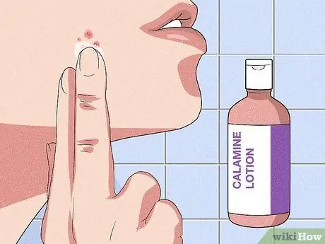 Исцеление от зудящих прыщей, шаг 3