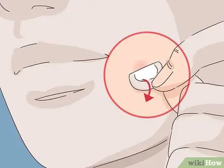 Избавиться от лопнувшего прыща за ночь, шаг 7