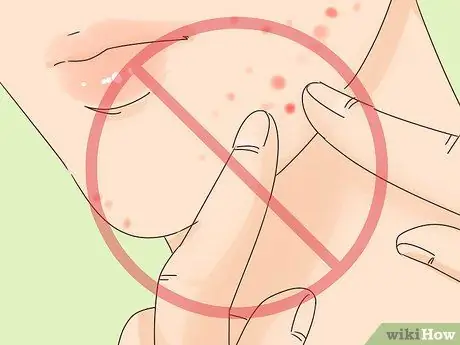 Избавиться от лопнувшего прыща за ночь, шаг 3