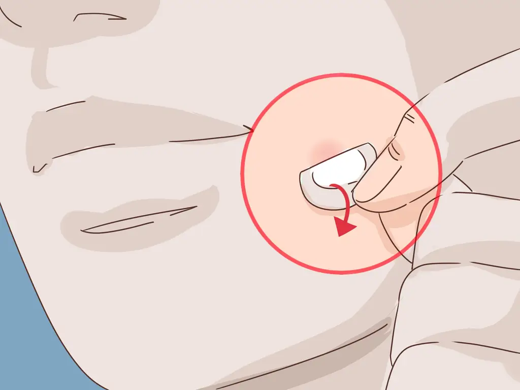 3 способа избавиться от лопнувшего прыща за ночь