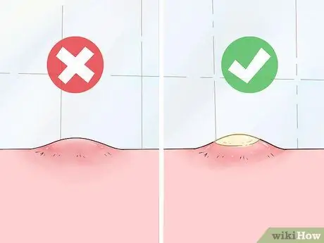 Безболезненно вытолкните прыщ Шаг 1