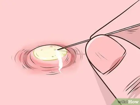 Безболезненно вытолкните прыщ Шаг 5