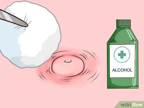 Безболезненно вытолкните прыщ Шаг 7