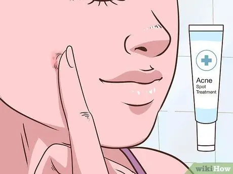 Безболезненно вытолкните прыщ Шаг 8