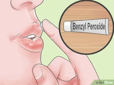 Быстрое избавление от прыщей вокруг губ, шаг 1