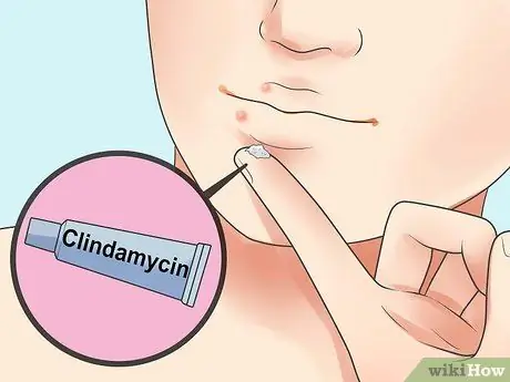 Быстрое избавление от прыщей вокруг губ, шаг 12