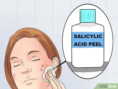 Очистить легкие угри, быстро, шаг 2