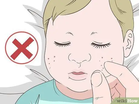 Избавиться от детских прыщей Шаг 4