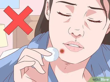 Как остановить кровотечение из прыщей Шаг 10 Как остановить кровотечение из прыщей Шаг 10