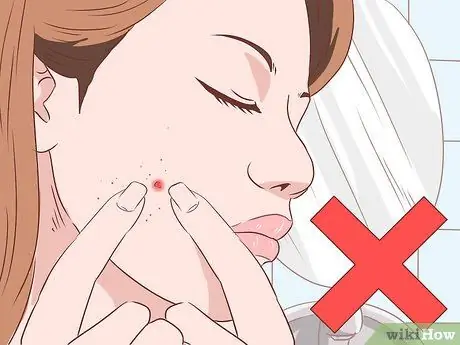 Как остановить кровотечение из прыщей Шаг 8 Как остановить кровотечение из прыщей Шаг 8