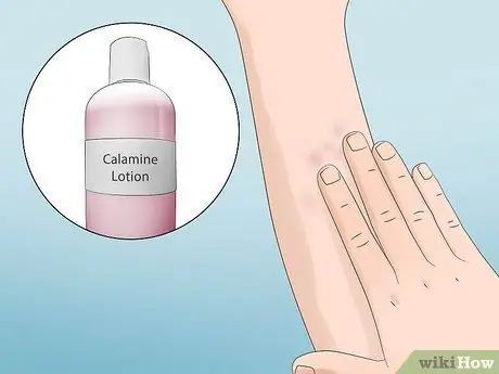 Лечите укусы инфицированных насекомых в домашних условиях Шаг 5