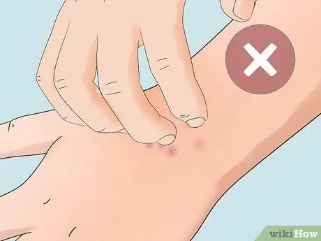 Лечите укусы инфицированных насекомых в домашних условиях Шаг 9