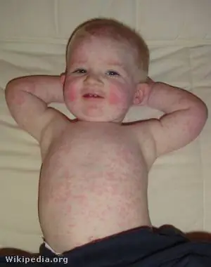 Ветряная оспа