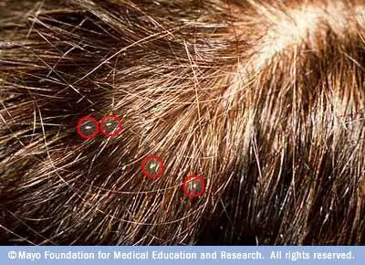 Козы обведены кружком на фото клиники Майо