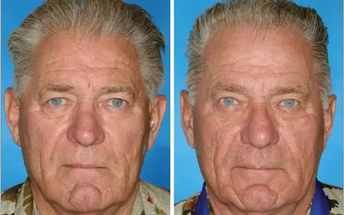 Фотографии близнецов доказывают, как эффектно старит курение