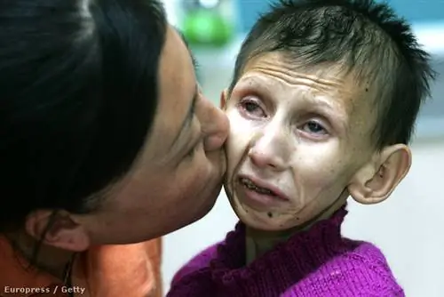 12-летняя девочка с синдромом Коккейна