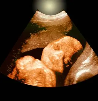 Плоды вакцинированы против коклюша в Калифорнии