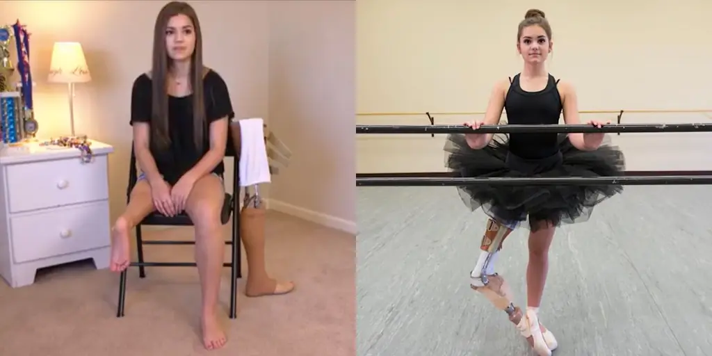 Молодая больная раком без ноги вдохновляет невероятным танцем (ВИДЕО)