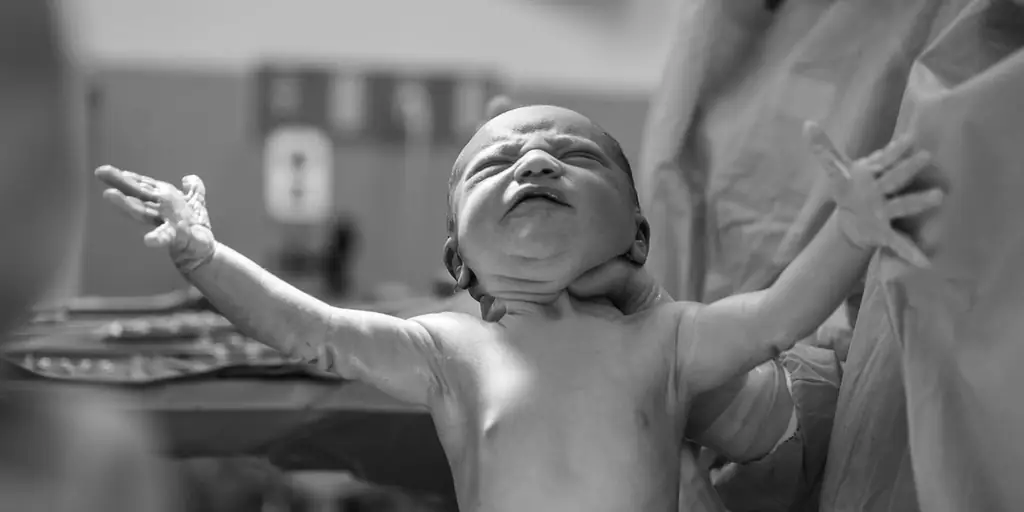 Отчет: «Эпидемическое» число кесаревых сечений по всему миру