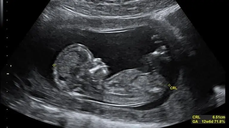 Взгляд на аборт с точки зрения телесной автономии - Кофе & Распятие