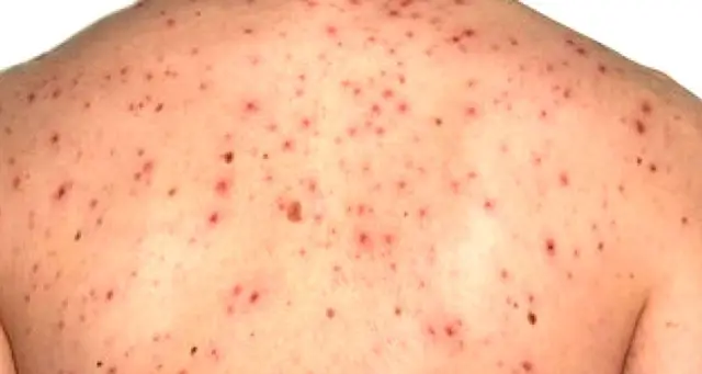 Корь четырежды возвращалась в Европу. Угадай почему